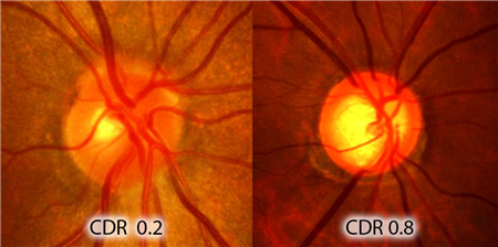 眼表眼角膜,希瑪瑞視眼科,上海眼科醫院