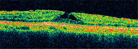 玻璃體視網(wǎng)膜,希瑪瑞視眼科,上海眼科醫(yī)院