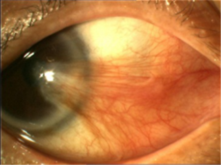 眼表眼角膜,希瑪瑞視眼科,上海眼科醫(yī)院