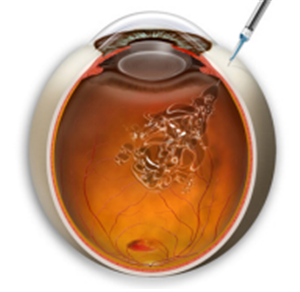 玻璃體視網膜,希瑪瑞視眼科,上海眼科醫院