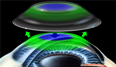 眼表眼角膜,希瑪瑞視眼科,上海眼科醫院