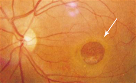 玻璃體視網(wǎng)膜,希瑪瑞視眼科,上海眼科醫(yī)院 玻璃體視網(wǎng)膜,希瑪瑞視眼科,上海眼科醫(yī)院