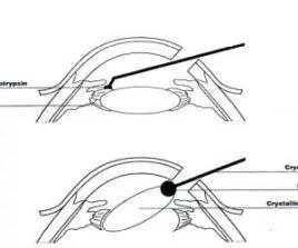 白內障,希瑪瑞視眼科,上海眼科醫院 白內障,希瑪瑞視眼科,上海眼科醫院