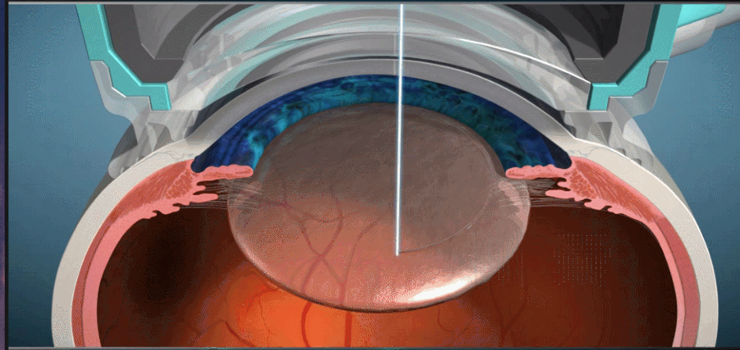 白內障,希瑪瑞視眼科,上海眼科醫院 白內障,希瑪瑞視眼科,上海眼科醫院