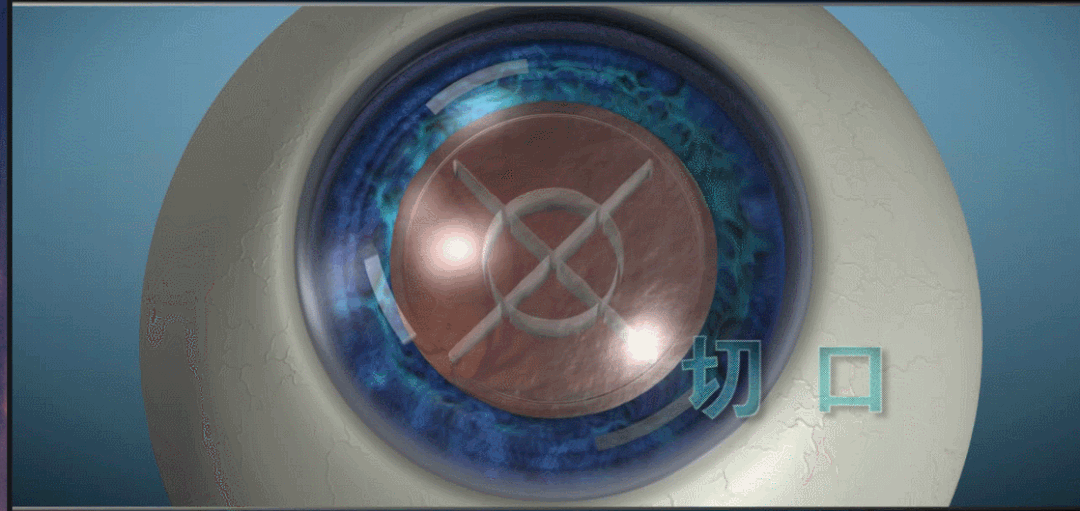 白內障,希瑪瑞視眼科,上海眼科醫院 白內障,希瑪瑞視眼科,上海眼科醫院