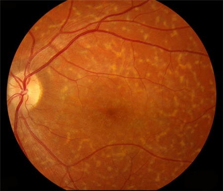 玻璃體視網(wǎng)膜,希瑪瑞視眼科,上海眼科醫(yī)院 玻璃體視網(wǎng)膜,希瑪瑞視眼科,上海眼科醫(yī)院