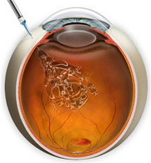玻璃體視網(wǎng)膜,希瑪瑞視眼科,上海眼科醫(yī)院 玻璃體視網(wǎng)膜,希瑪瑞視眼科,上海眼科醫(yī)院