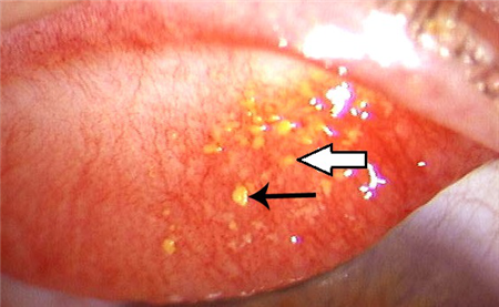 眼表眼角膜,希瑪瑞視眼科,上海眼科醫院