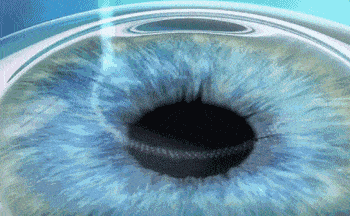 屈光矯視,希瑪瑞視眼科,上海眼科醫(yī)院 屈光矯視,希瑪瑞視眼科,上海眼科醫(yī)院