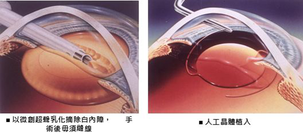 小兒眼病,希瑪瑞視眼科,上海眼科醫院