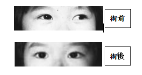 小兒眼病,希瑪瑞視眼科,上海眼科醫(yī)院