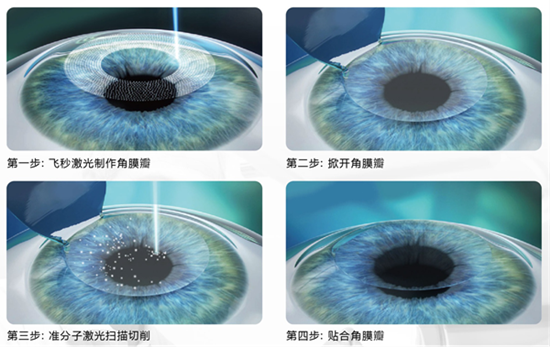 屈光矯視,希瑪瑞視眼科,上海眼科醫院 屈光矯視,希瑪瑞視眼科,上海眼科醫院