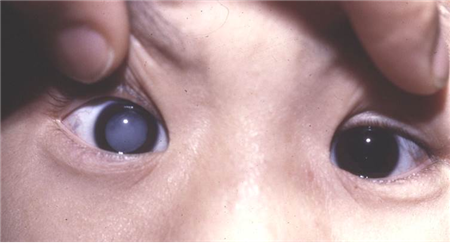 白內障,希瑪瑞視眼科,上海眼科醫院