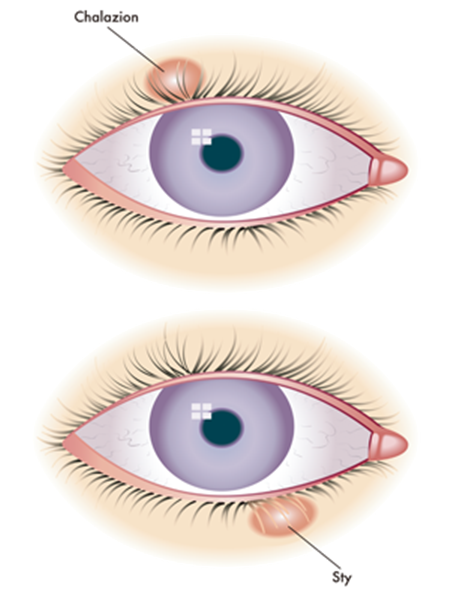 眼表眼角膜,希瑪瑞視眼科,上海眼科醫院