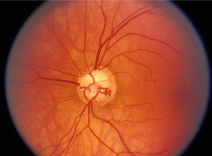 青光眼?？?/>
		</div>
		<div   id=