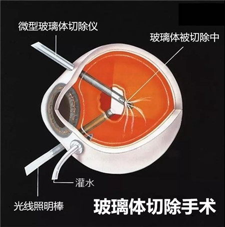 玻璃體視網膜,希瑪瑞視眼科,上海眼科醫院 玻璃體視網膜,希瑪瑞視眼科,上海眼科醫院